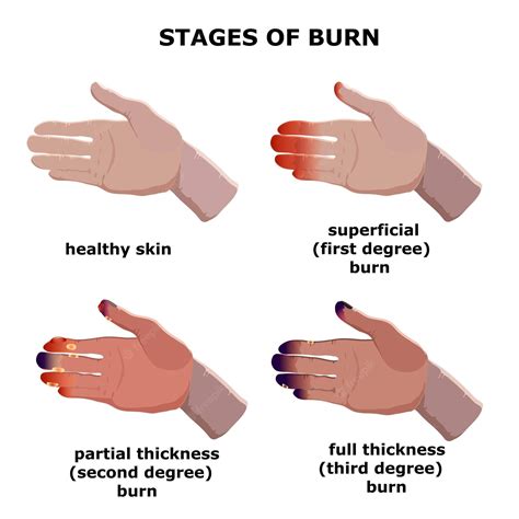 Sunburn severity: First and second degree symptoms